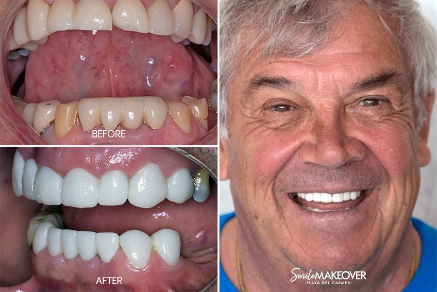 pacientes con diseño de sonrisa