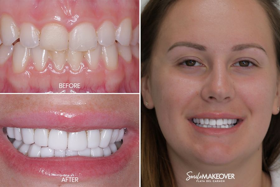 pacientes con diseño de sonrisa