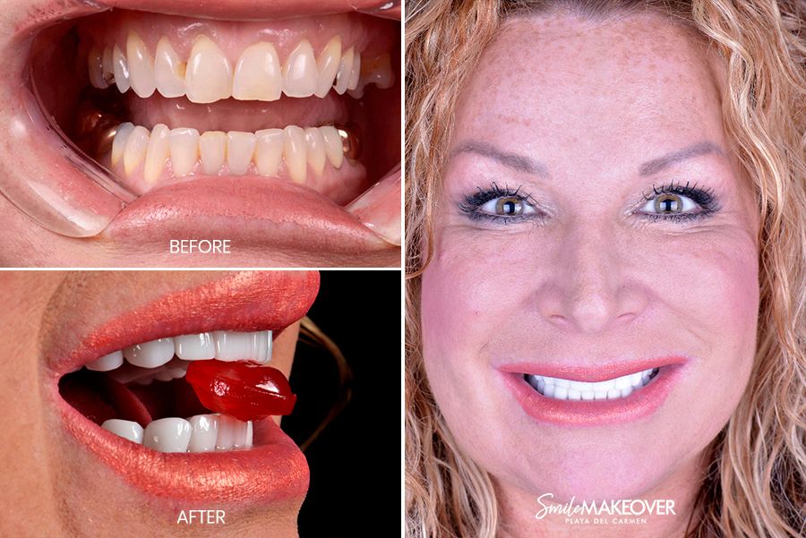 pacientes con diseño de sonrisa