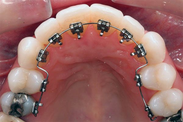 frenos dentales lingual